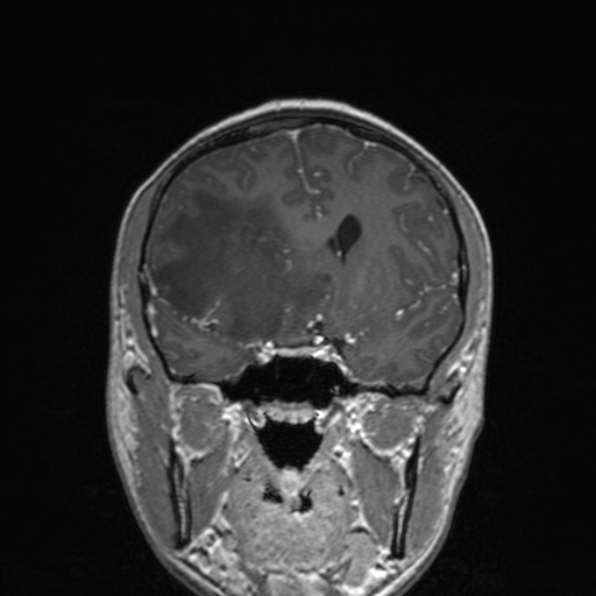 Cerebral abscess (Radiopaedia 24212-24478 Coronal T1 C+ 91).jpg