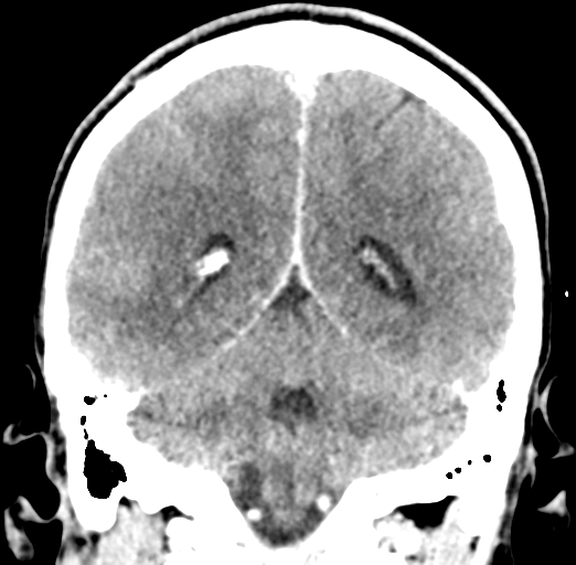 Cerebral abscess (Radiopaedia 60342-68008 Coronal C+ delayed 45).png