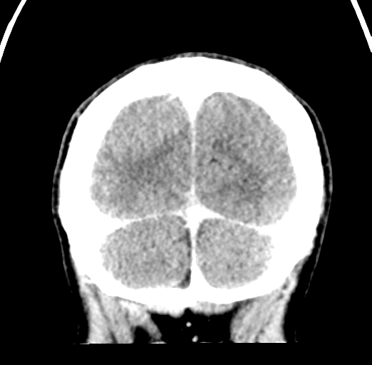 Cerebral abscess (Radiopaedia 60342-68008 Coronal C+ delayed 57).png