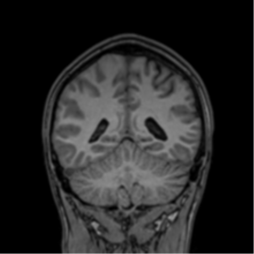 Cerebral abscess (Radiopaedia 60342-68009 Coronal T1 12).png