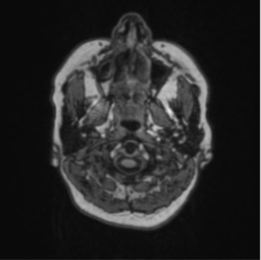 Cerebral abscess from pulmonary arteriovenous malformation (Radiopaedia 86275-102291 Axial T1 2).png
