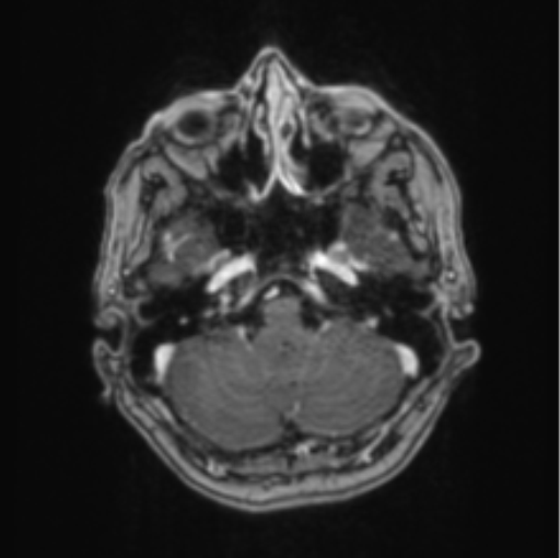 Cerebral abscess from pulmonary arteriovenous malformation (Radiopaedia 86275-102291 Axial T1 C+ 18).png
