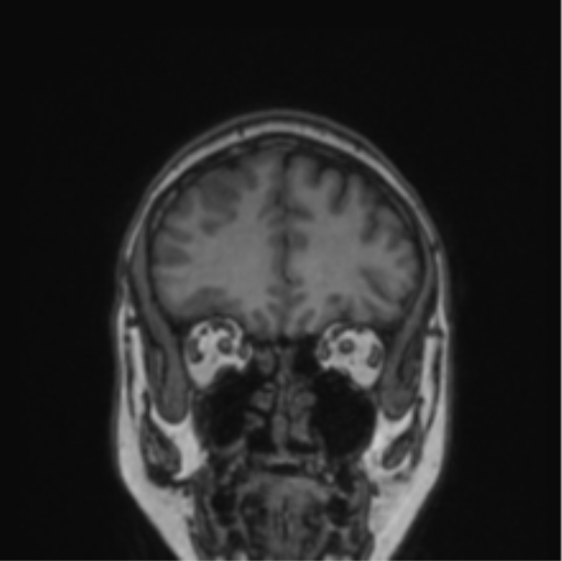 Cerebral abscess from pulmonary arteriovenous malformation (Radiopaedia 86275-102291 Coronal T1 69).png
