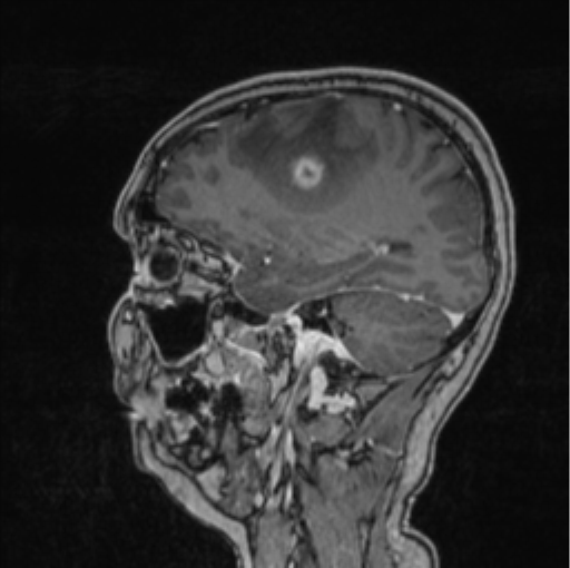Cerebral abscess from pulmonary arteriovenous malformation (Radiopaedia 86275-102291 Sagittal T1 C+ 52).png