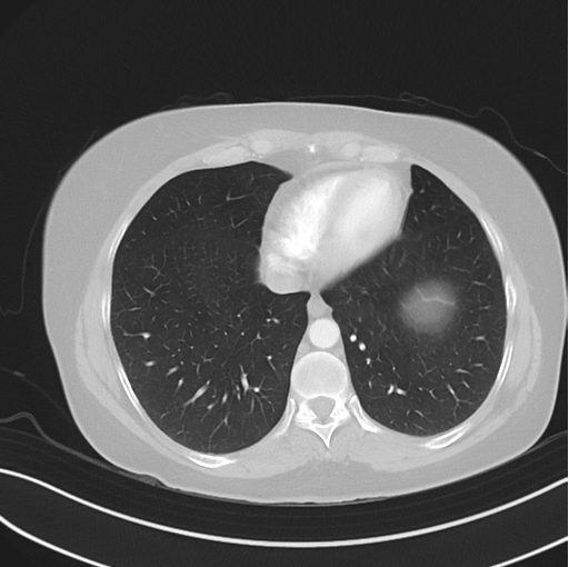 Cerebral abscess from pulmonary arteriovenous malformation (Radiopaedia 86275-102292 Axial lung window 44).png