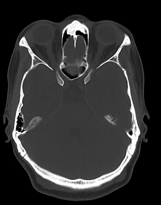Cerebral abscesses (Radiopaedia 70458-80568 Axial bone window 22).jpg