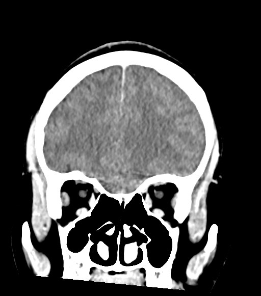 Cerebral abscesses (Radiopaedia 70458-80568 Coronal Contrast 19).jpg
