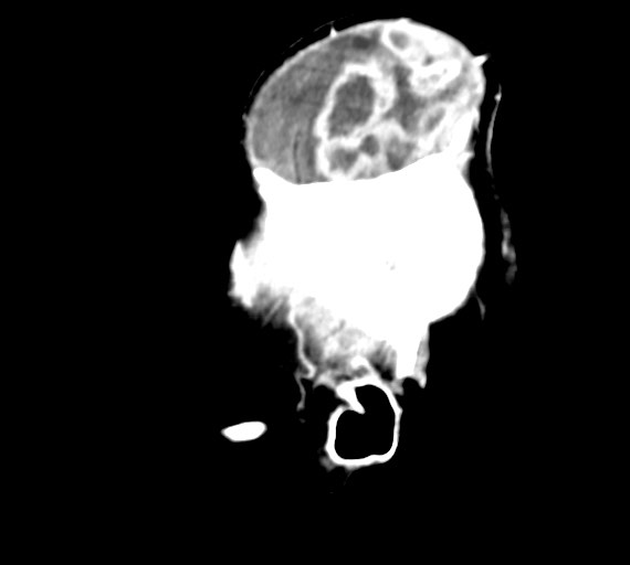Cerebral abscesses (Radiopaedia 70458-80568 Sagittal Contrast 7).jpg