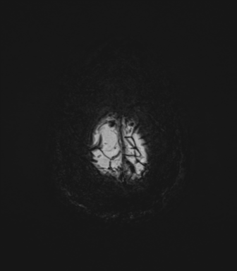 File:Cerebral amyloid angiopathy (Radiopaedia 46082-50433 Axial SWI MIP 77).png
