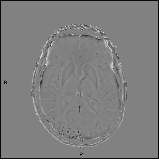 Cerebral amyloid angiopathy (Radiopaedia 77506-89664 H 55).jpg