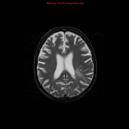 File:Cerebral and orbital tuberculomas (Radiopaedia 13308-13311 Axial T2 14).jpg