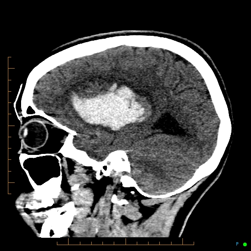 File:Cerebral arteriovenous malformation (AVM) (Radiopaedia 78162-90706 A 26).jpg