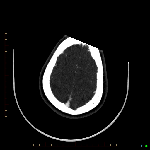 Cerebral arteriovenous malformation (AVM) (Radiopaedia 78162-90706 Axial CTA 235).jpg