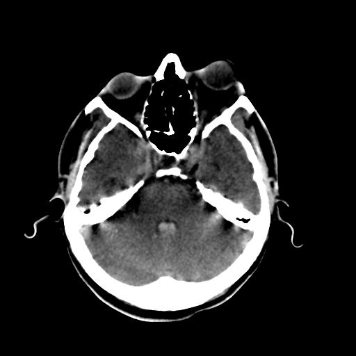 Cerebral arteriovenous malformation (Radiopaedia 28518-28759 Axial non-contrast 20).jpg
