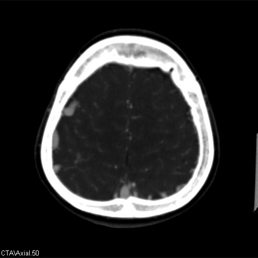 Cerebral arteriovenous malformation (Radiopaedia 28518-28759 B 50).jpg