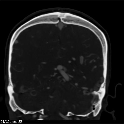 File:Cerebral arteriovenous malformation (Radiopaedia 28518-28759 C 55).jpg
