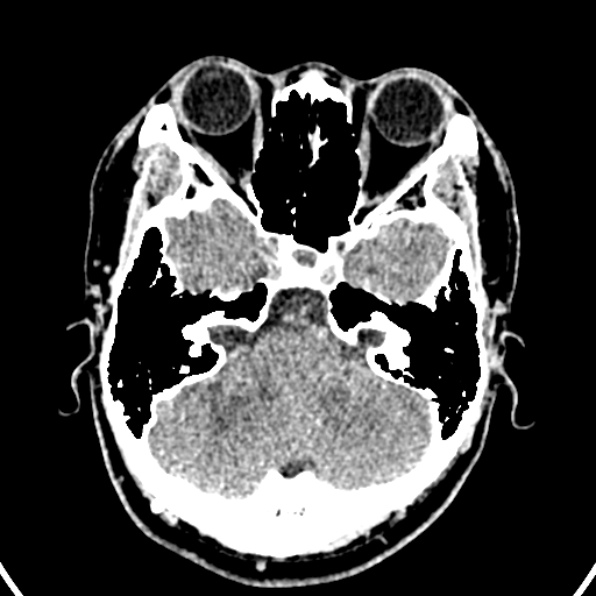 Cerebral arteriovenous malformation (Radiopaedia 37182-39012 Axial non-contrast 10).jpg