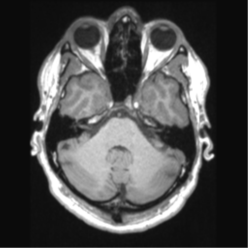 File:Cerebral arteriovenous malformation (Radiopaedia 39259-41506 Axial T1 21).png