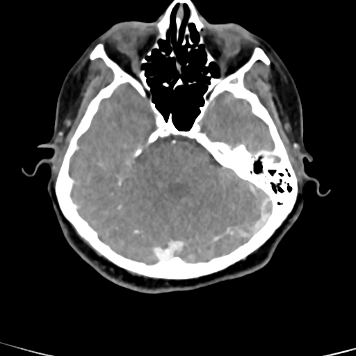 Cerebral arteriovenous malformation (Radiopaedia 73830-84645 B 71).jpg