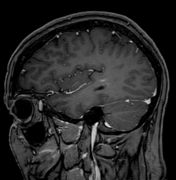 Cerebral arteriovenous malformation (Radiopaedia 74411-85746 Sagittal T1 C+ 29).jpg