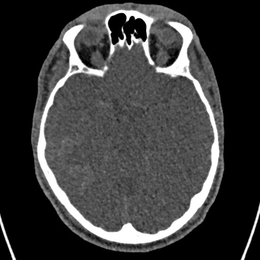 Cerebral arteriovenous malformation (Radiopaedia 78188-90746 Axial non-contrast 68).jpg