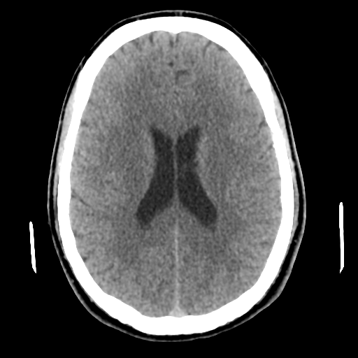 Cerebral arteriovenous malformation (Spetzler-Martin grade 2) (Radiopaedia 41262-44076 Axial non-contrast 34).png