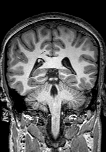 Cerebral arteriovenous malformation at posterior body of corpus callosum (Radiopaedia 74111-84925 Coronal T1 221).jpg