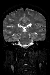 Cerebral arteriovenous malformation at posterior body of corpus callosum (Radiopaedia 74111-84925 Coronal T2 103).jpg