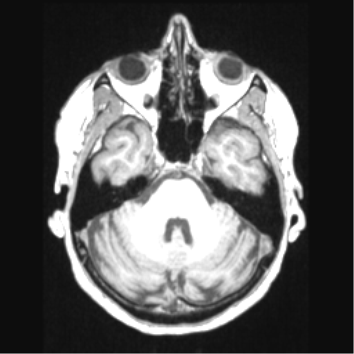 Cerebral arteriovenous malformation with hemorrhage (Radiopaedia 34422-35737 Axial T1 22).png