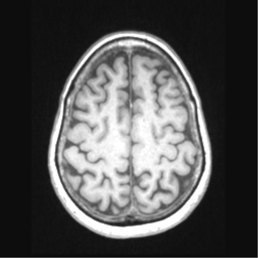 File:Cerebral arteriovenous malformation with hemorrhage (Radiopaedia 34422-35737 Axial T1 59).png