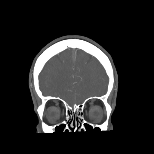 Cerebral arteriovenous malformation with lobar hemorrhage (Radiopaedia 35598-57216 C 18).jpg