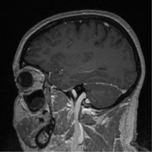File:Cerebral cavernoma and development venous anomaly (Radiopaedia 37603-39482 Sagittal T1 C+ 67).png