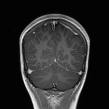 Cerebral cavernous venous malformation (Radiopaedia 70008-80021 Coronal T1 C+ 16).jpg