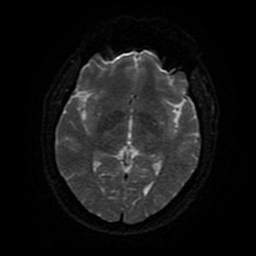 File:Cerebral cavernous venous malformation (Zabramski type II) (Radiopaedia 85511-101198 Axial DWI 82).jpg