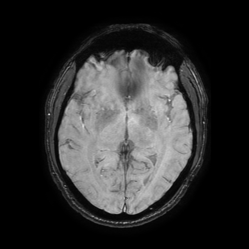 Cerebral cavernous venous malformation (Zabramski type II) (Radiopaedia 85511-101198 Axial SWI 63).jpg