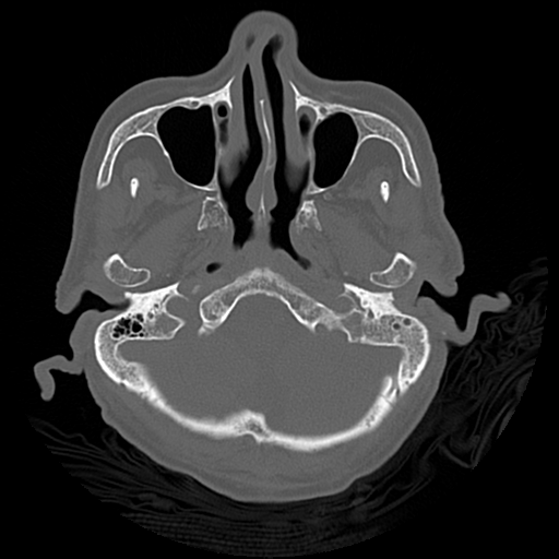 Cerebral contusions, subarachnoid hemorrhage and subdural hygromas (Radiopaedia 55399-61827 Axial bone window 9).png
