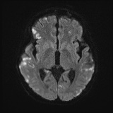 Cerebral embolic infarcts (embolic shower) (Radiopaedia 72391-82921 Axial DWI 44).jpg