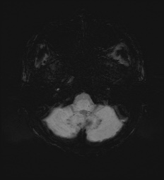 Cerebral embolic infarcts (embolic shower) (Radiopaedia 72391-82921 Axial SWI 10).jpg
