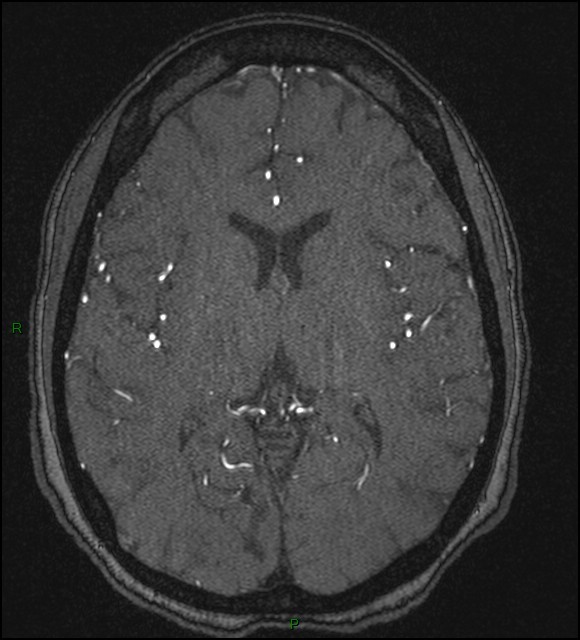 Cerebral fat embolism (Radiopaedia 35022-36525 Axial TOF 111).jpg
