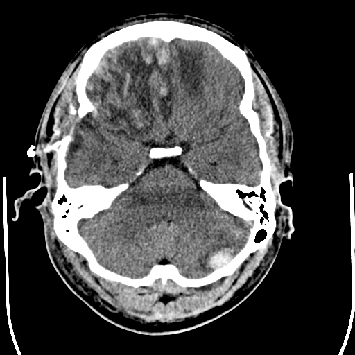 File:Cerebral hemorrhagic contusions- temporal evolution (Radiopaedia 40224-42755 AXIAL THICK 8).png