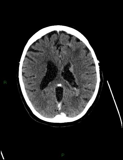 File:Cerebral metastases - ependymal and parenchymal (Radiopaedia 79877-93131 Axial C+ delayed 51).jpg