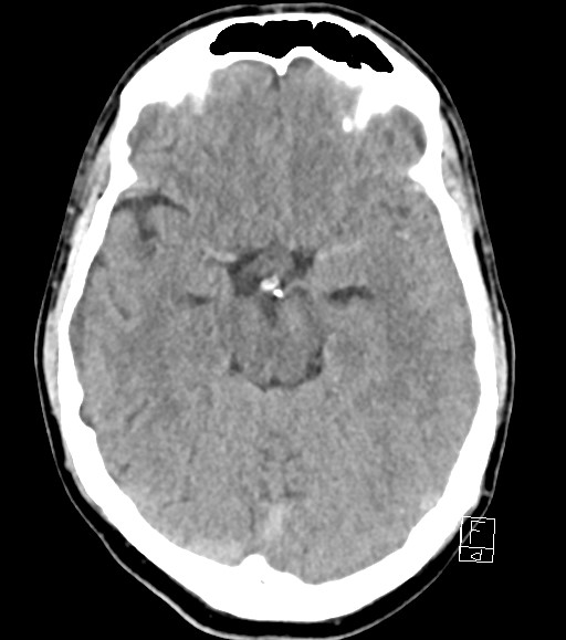 Cerebral metastases - testicular choriocarcinoma (Radiopaedia 84486-99855 Axial non-contrast 35).jpg