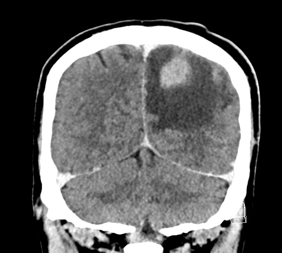 Cerebral metastases - testicular choriocarcinoma (Radiopaedia 84486-99855 D 48).jpg