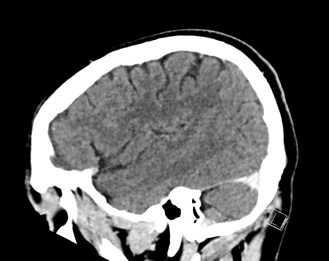 Cerebral metastases - testicular choriocarcinoma (Radiopaedia 84486-99855 F 44).jpg