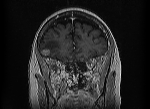 Cerebral metastases from lung cancer with amyloid angiopathy and cerebellopontine angle meningioma (Radiopaedia 74306-85191 Coronal T1 C+ 14).jpg
