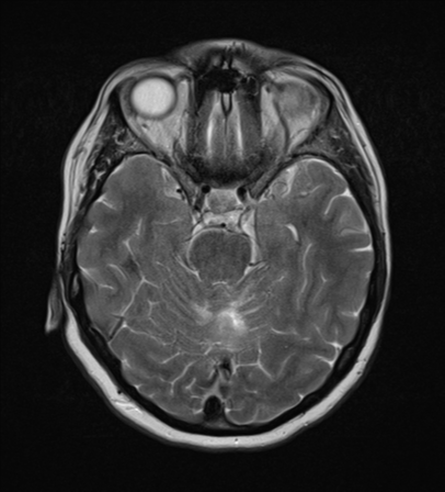 File:Cerebral metastases mimicking abscesses (Radiopaedia 45841-50131 Axial T2 11).png