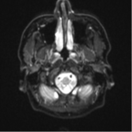 Cerebral metastasis - colorectal adenocarcinoma (Radiopaedia 50394-55765 Axial DWI 1).png