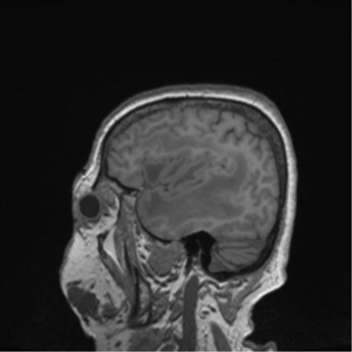 Cerebral metastasis to basal ganglia (Radiopaedia 81568-95413 Sagittal T1 62).png