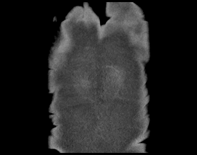 Cerebral metastasis to basal ganglia (Radiopaedia 81568-95414 C 51).png
