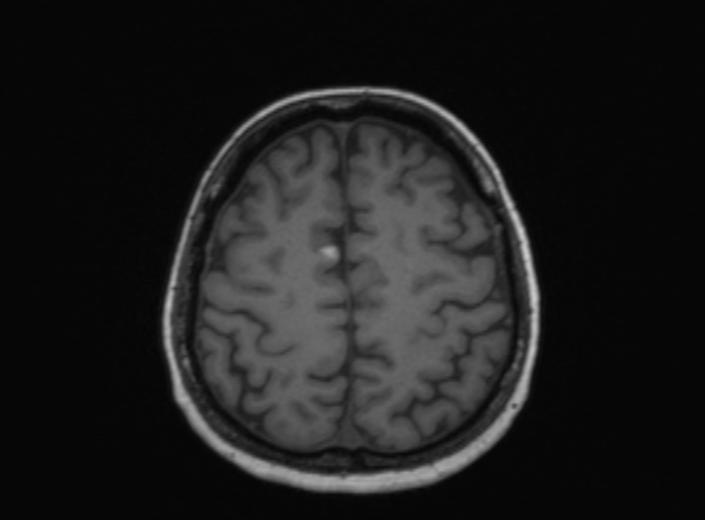 Cerebral ring enhancing lesions - cerebral metastases (Radiopaedia 44922-48817 Axial T1 154).jpg